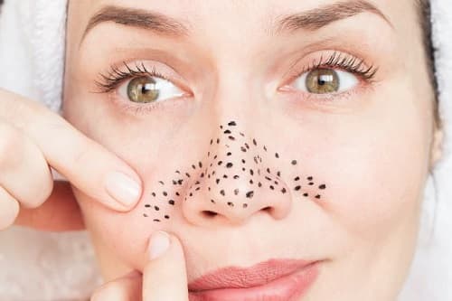 SİYAH NOKTALAR VE GÖZENEKLER HAKKINDA BİLİNMESİ GEREKEN HERŞEY